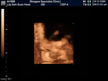 Vivian Sonograms